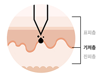 색소주입