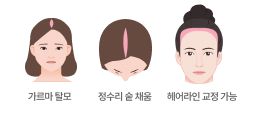 여성 탈모 정수리 숱채움 헤어라인